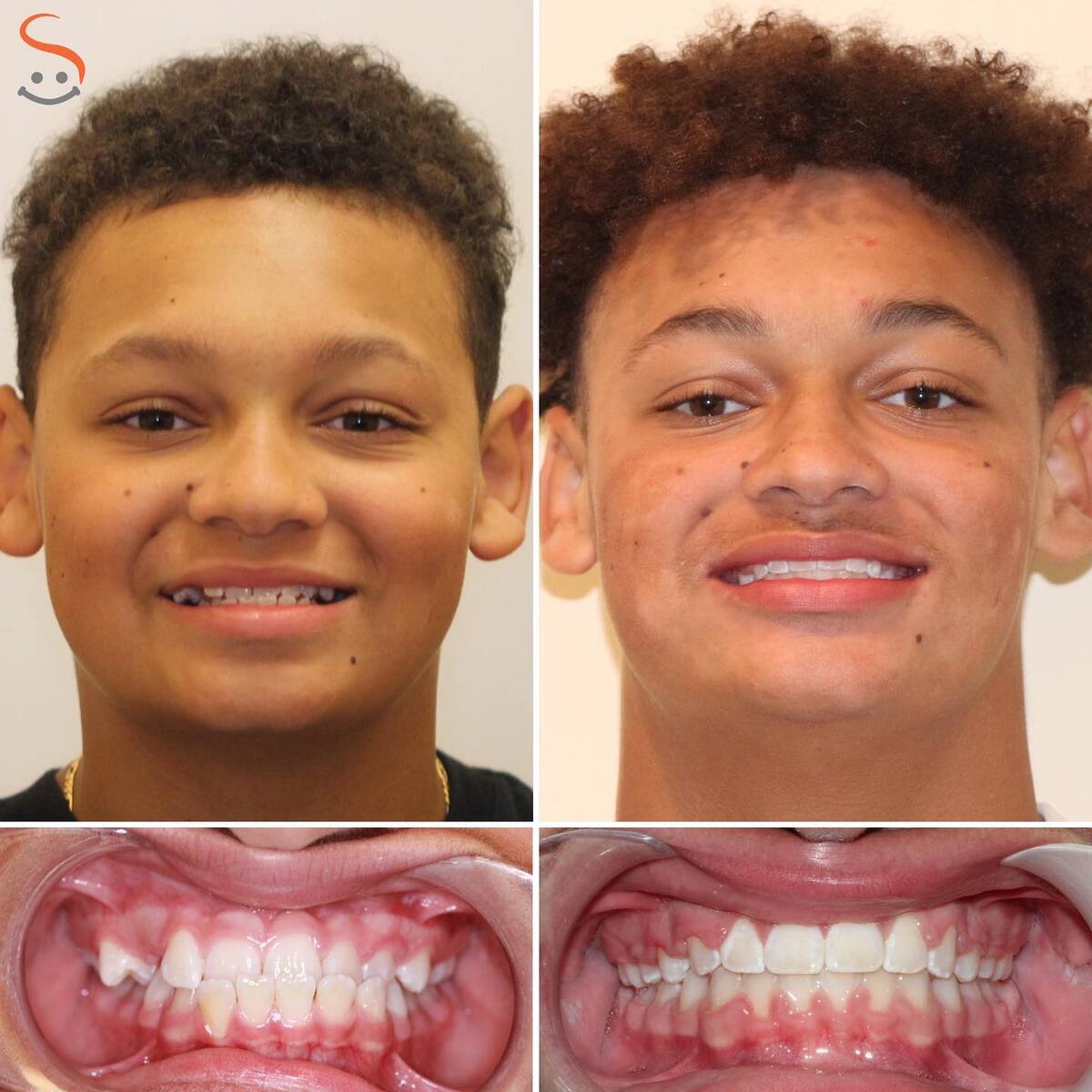 Man smiling before and after including close-up of teeth